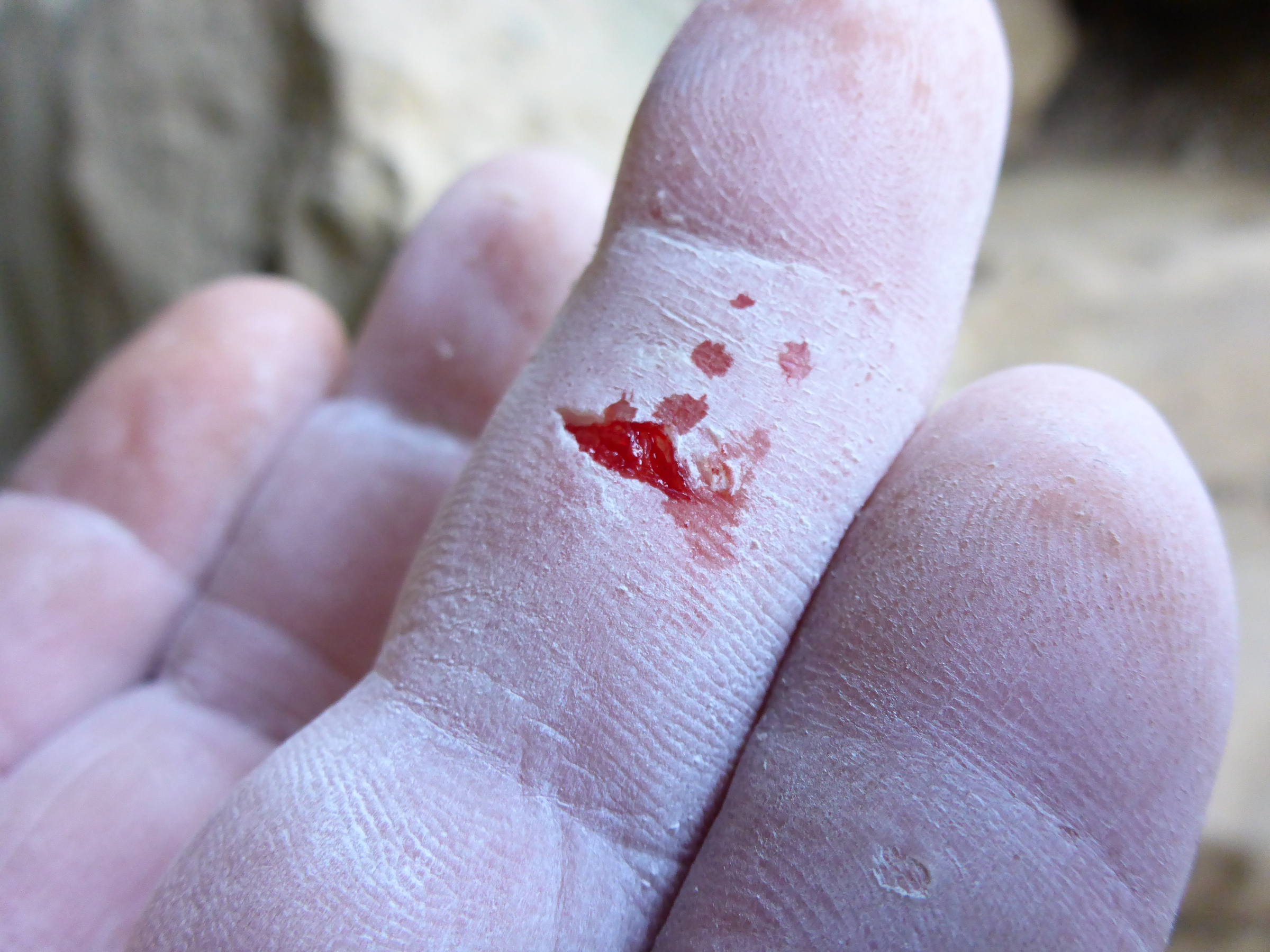 Ring Pulls Skin Off Finger Ring Pulls Skin Off Finger